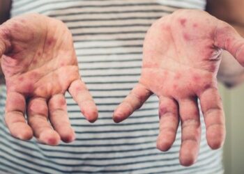 OMS alerta sobre forte aumento de casos de sarampo no mundo